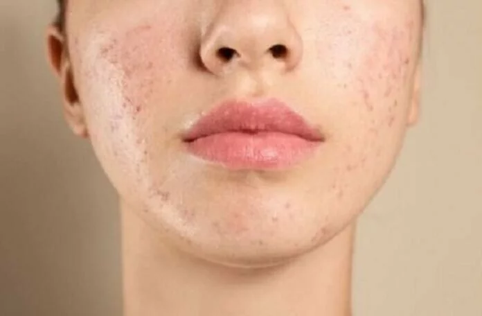 Home Remedies for Abscess: अगर आप फोड़े-फुंसियों से परेशान हैं तो तुरंत अपनाएं घरेलू उपाय