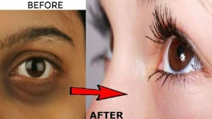  How to remove dark circles: ये हैं वो 3 चीजें जो हटा देंगी आंखों के नीचे मौजूद काले घेरे, चेहरा दिखने लगेगा खूबसूरत